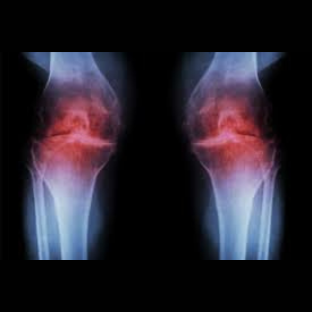 People think knee pain is inevitable as they age. That may not be the case.