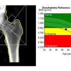 A Dual-energy X-ray absorptiometry scan measures body composition and bone density in different parts of the body. It is one of the many tools researchers at Wake Forest University are using as part of a new study. 