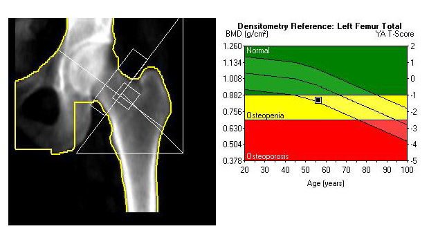 What Is a DEXA Scan? - University Health News