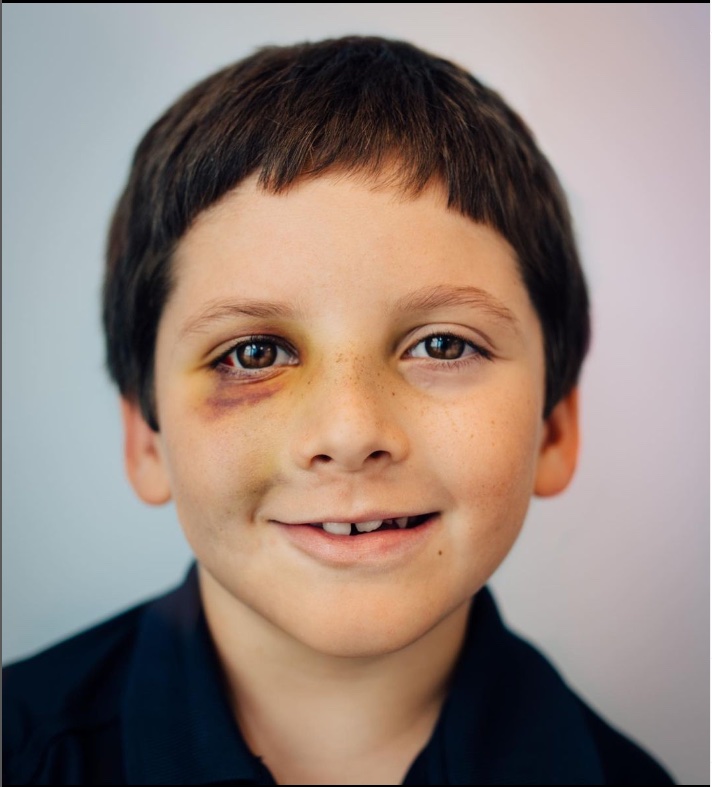 A boy's face with a black eye and a smile on his face