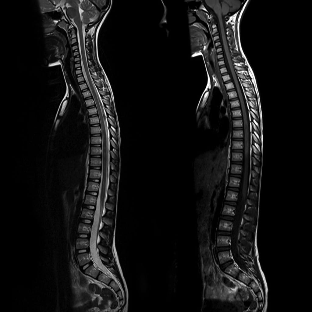 X-ray showing spinal injuries