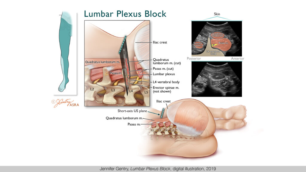 medical illustration of the lower spine within a white skinned body, with close up images of vertebrae and nerves